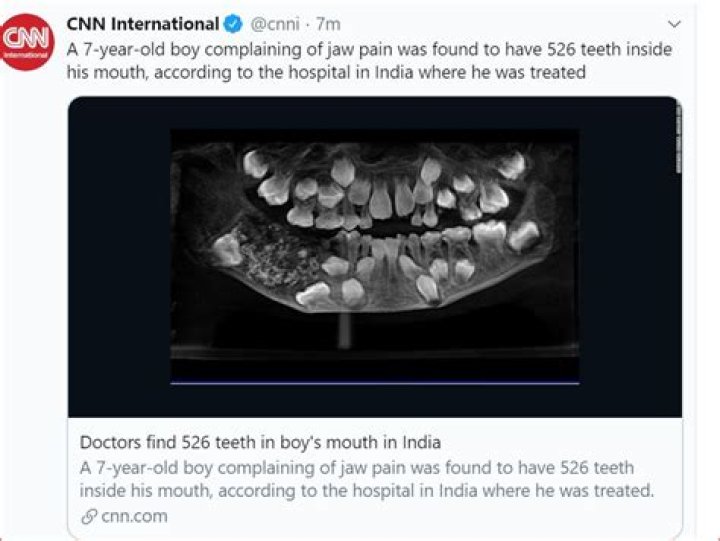 Doctors Find 526 Teeth In Boy's Mouth After Complaints Of Jaw Pain