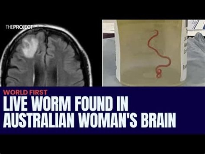 Doctors Found A Three-Inch Worm Living In A Woman's Brain