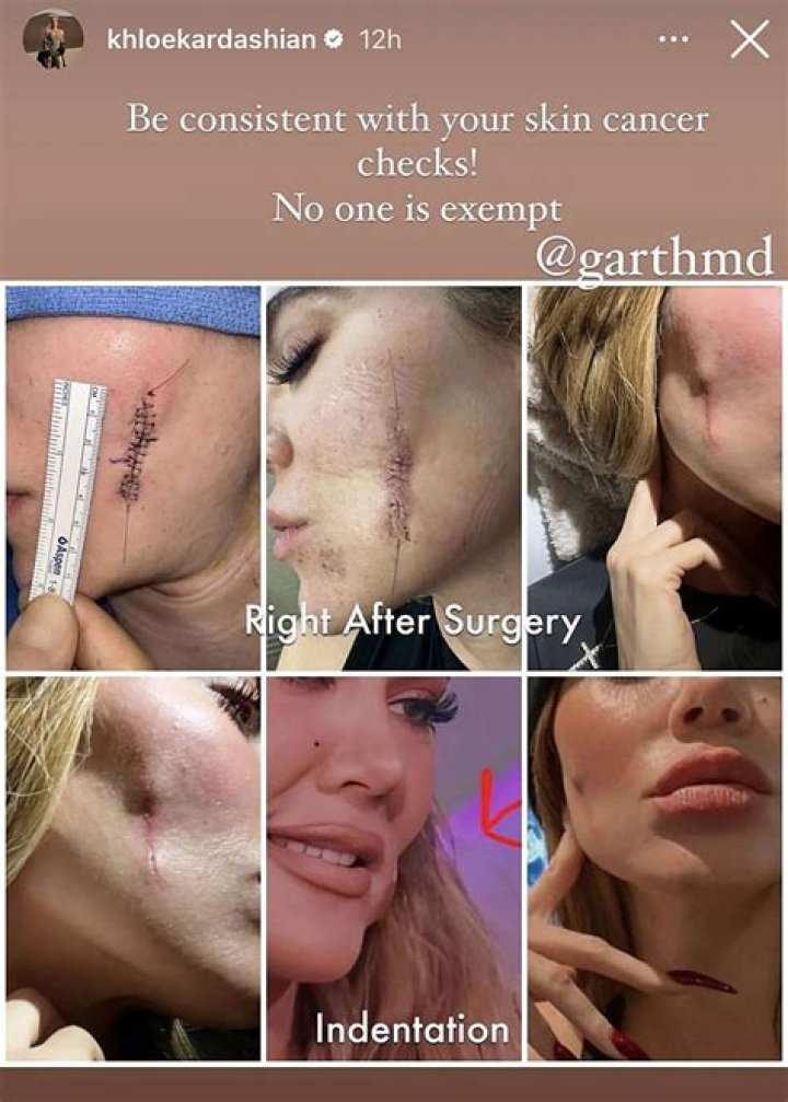 Does Khloe Kardashian Have Melanoma? Inside Her Battle With Skin Cancer ​Over the Years