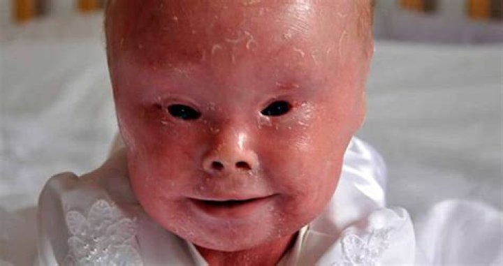 Photos And Stories Of The Rare Skin Disease
