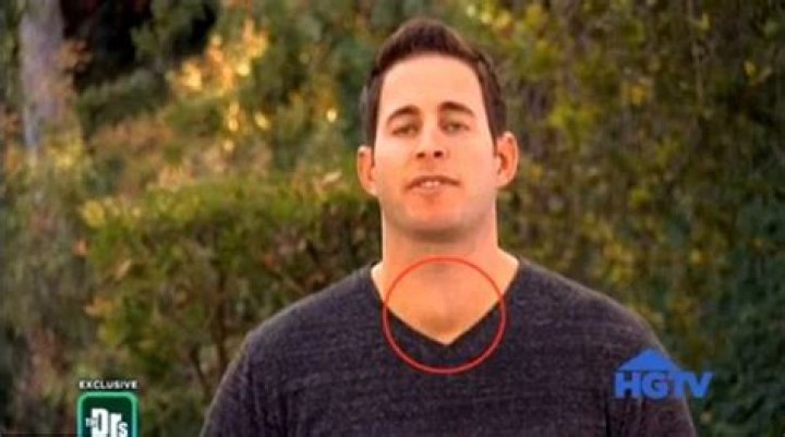  Tarek El Moussa Thyroid Cancer: Current Health Update.