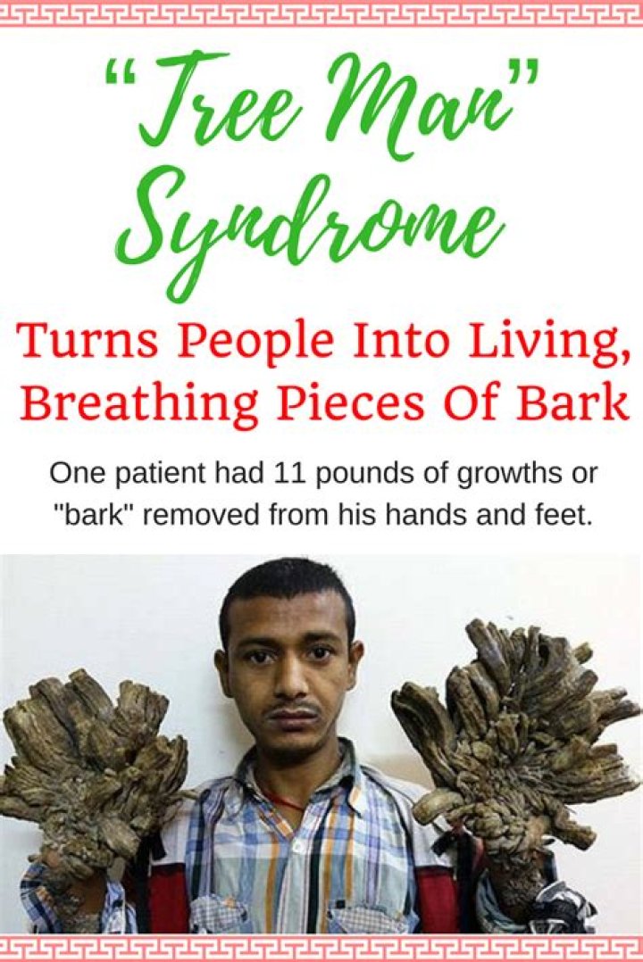 "Tree Man" Syndrome Turns People Into Living, Breathing Pieces Of Bark