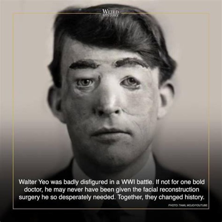Walter Yeo, The Story Of The First Plastic Surgery Patient In History